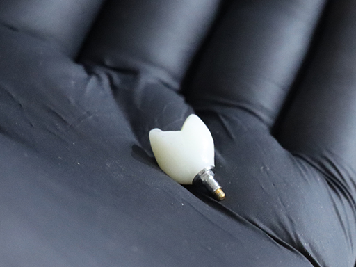 Dental implant and crown restoration